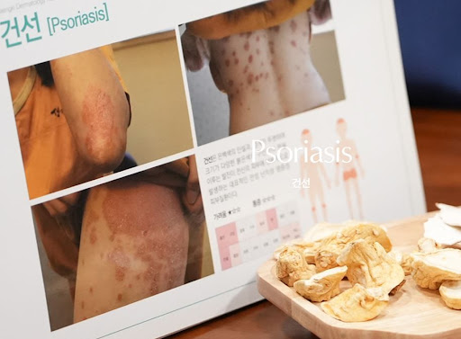 생기한의원으로 살펴보는 두피 건선과 비듬의 차이